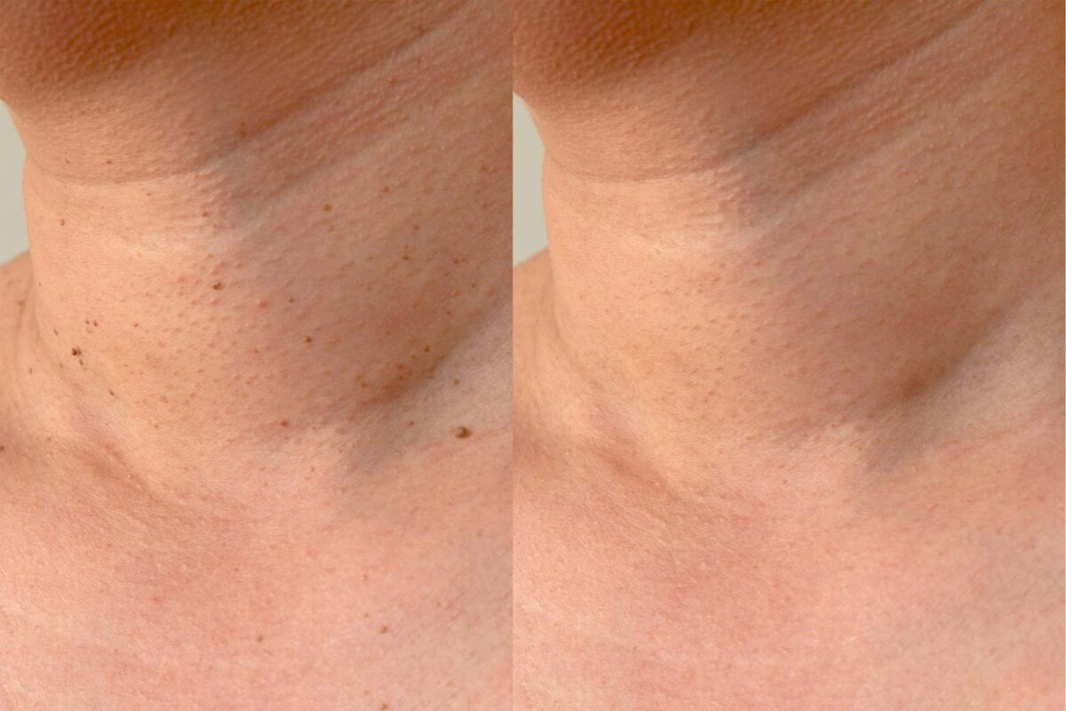 before and after skin tag removal sacramento california