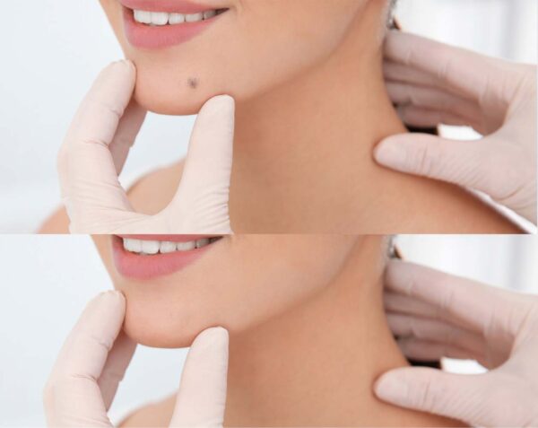 cost of mole removal elk grove california