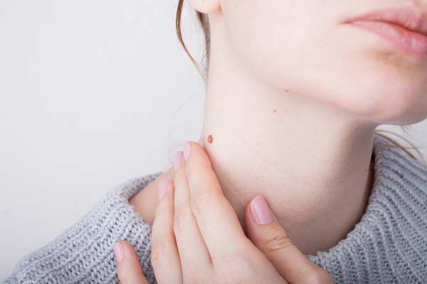 neck skin tag removal Sacramento California