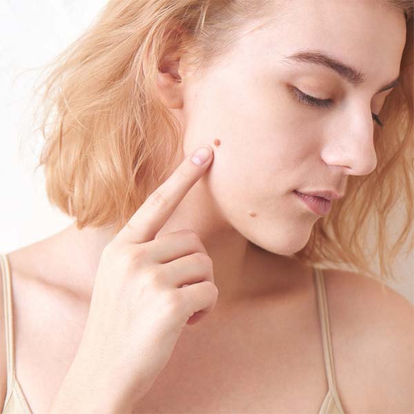 affordable mole removal folsom california