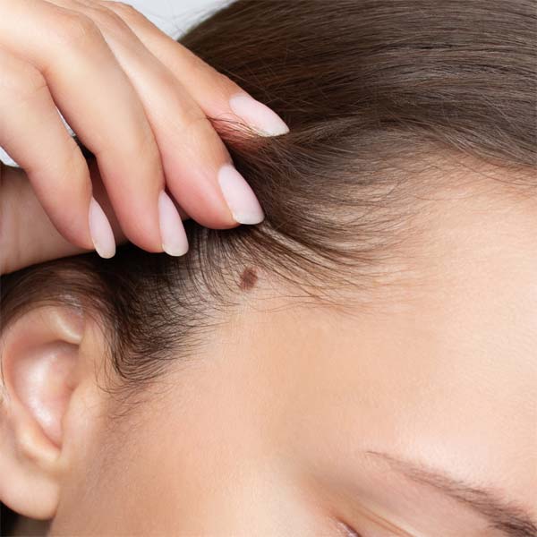 expert mole removal folsom california