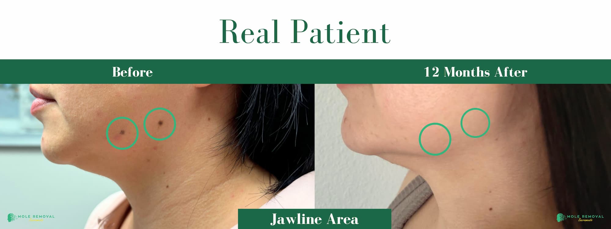 SAC New before_after #14 (1)