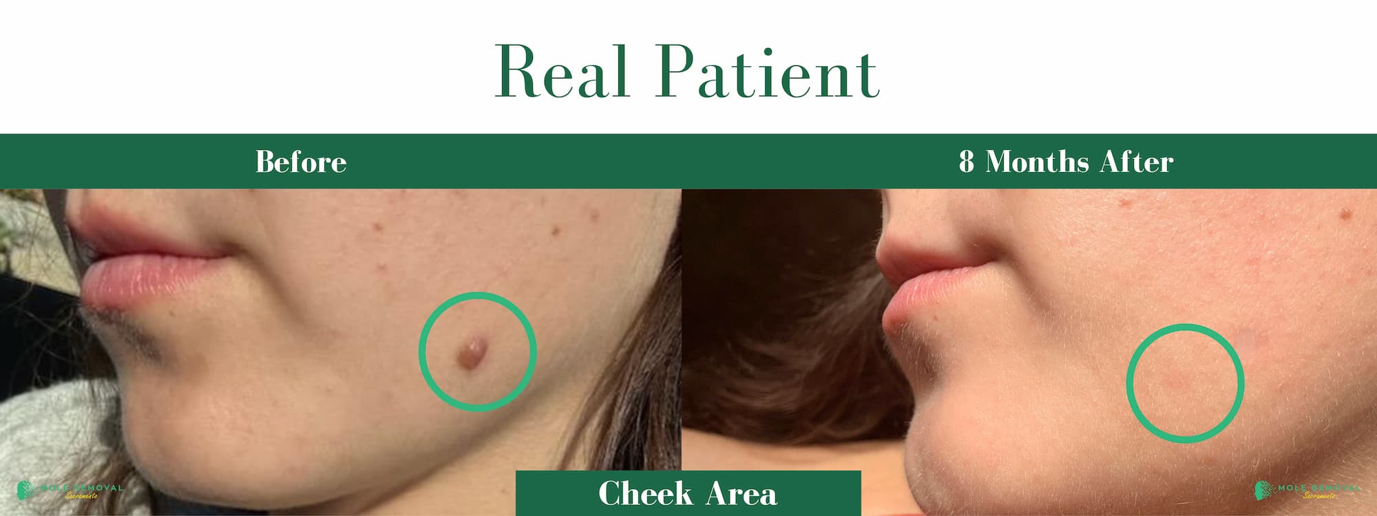 SAC New before_after #19 (1)