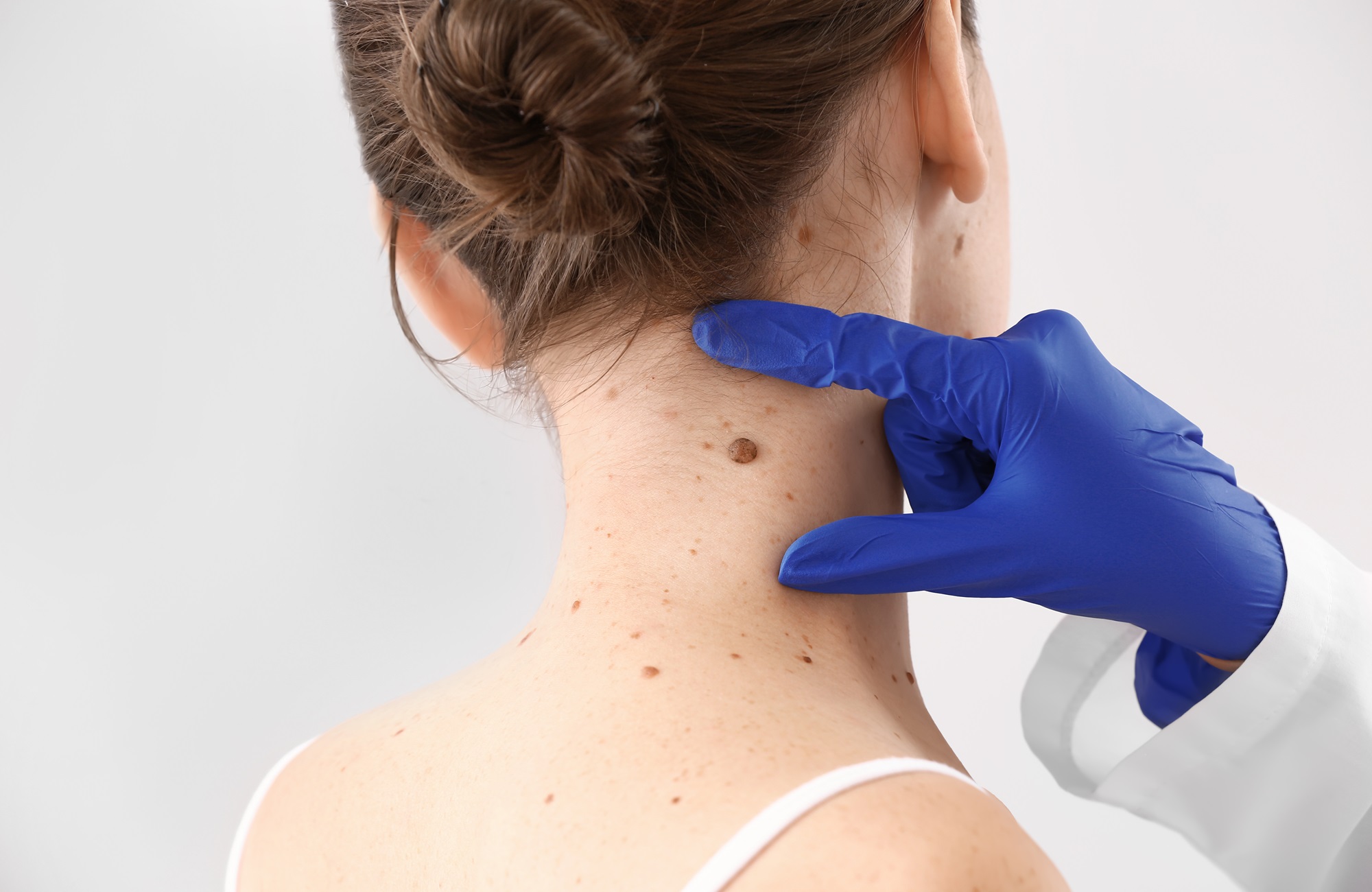 affordable mole removal roseville california