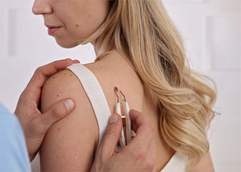 top rated mole removal sacramento california