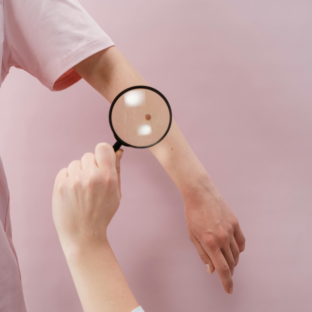 affordable mole removal Arden-Arcade california