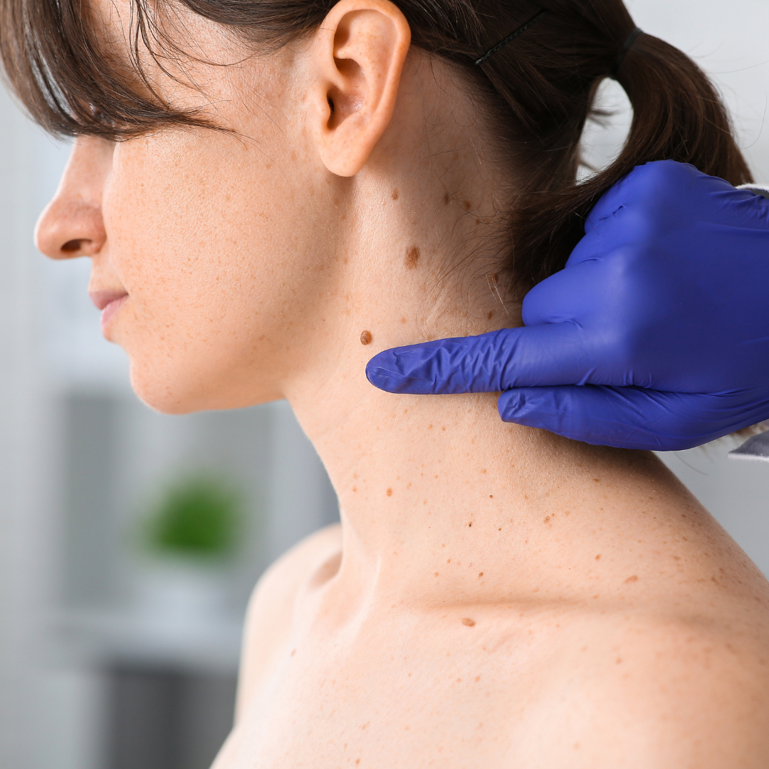 affordable mole removal Granite Bay