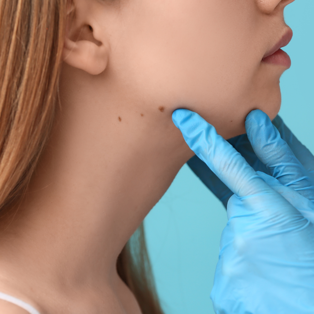 top rated mole removal Davis california