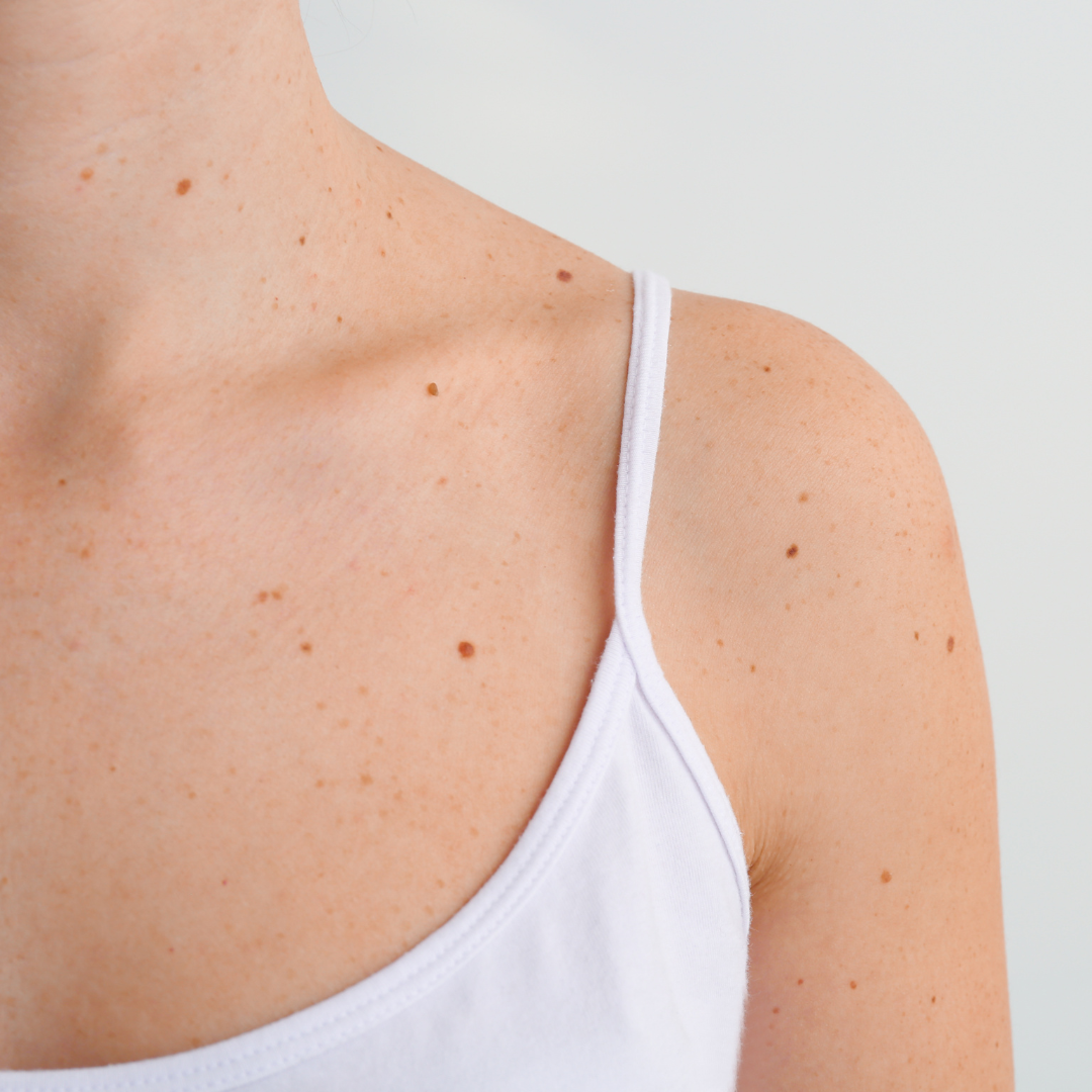 Learn More About At-Home Mole Removal