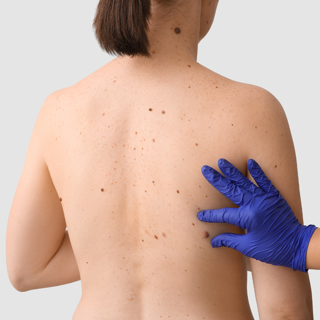 Who Should Remove Your Mole