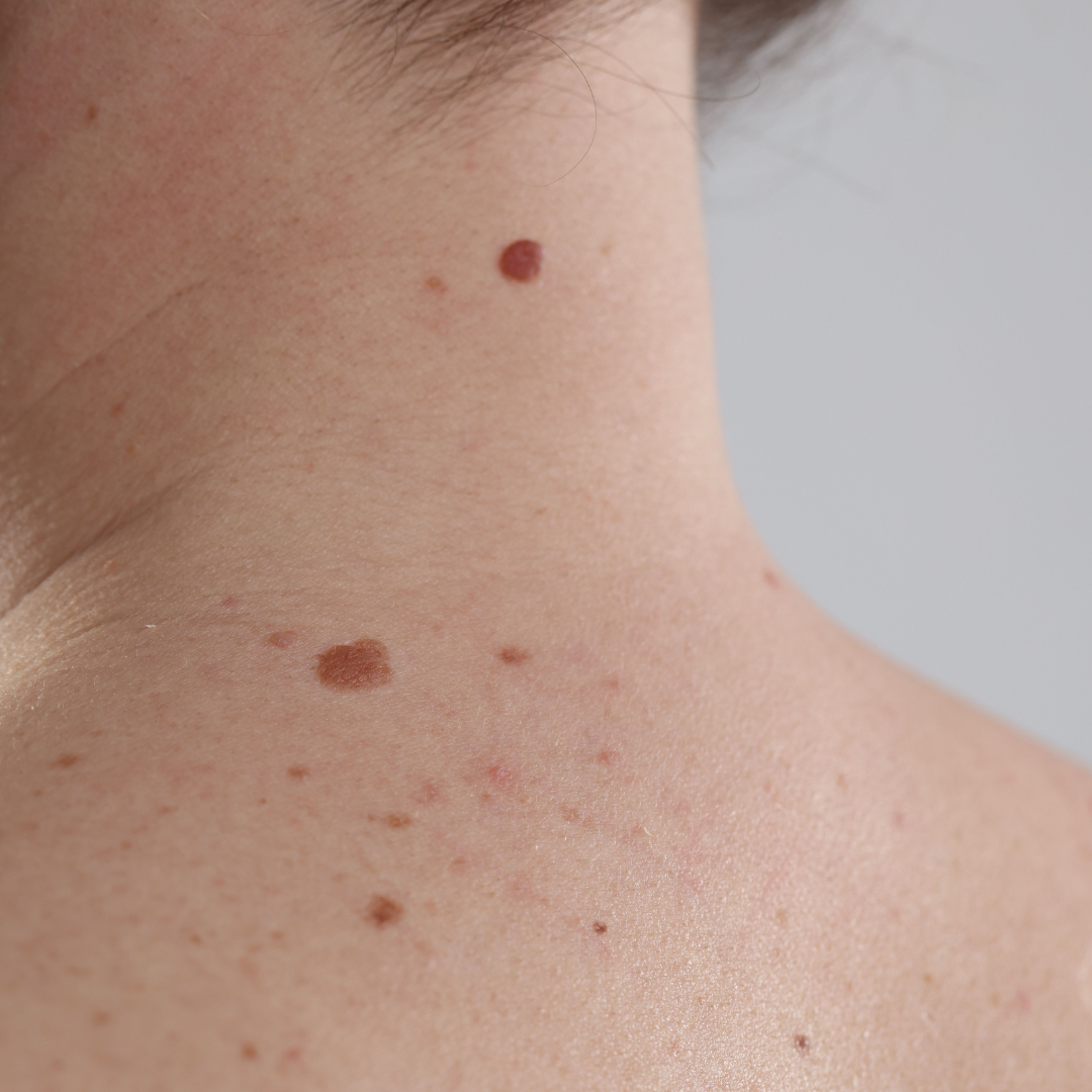 expert mole removal Rocklin california image