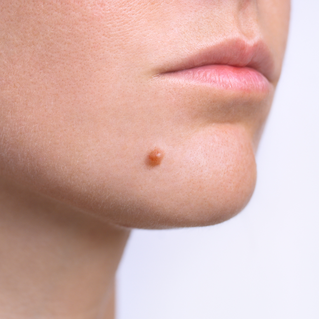 learn about facial mole removal