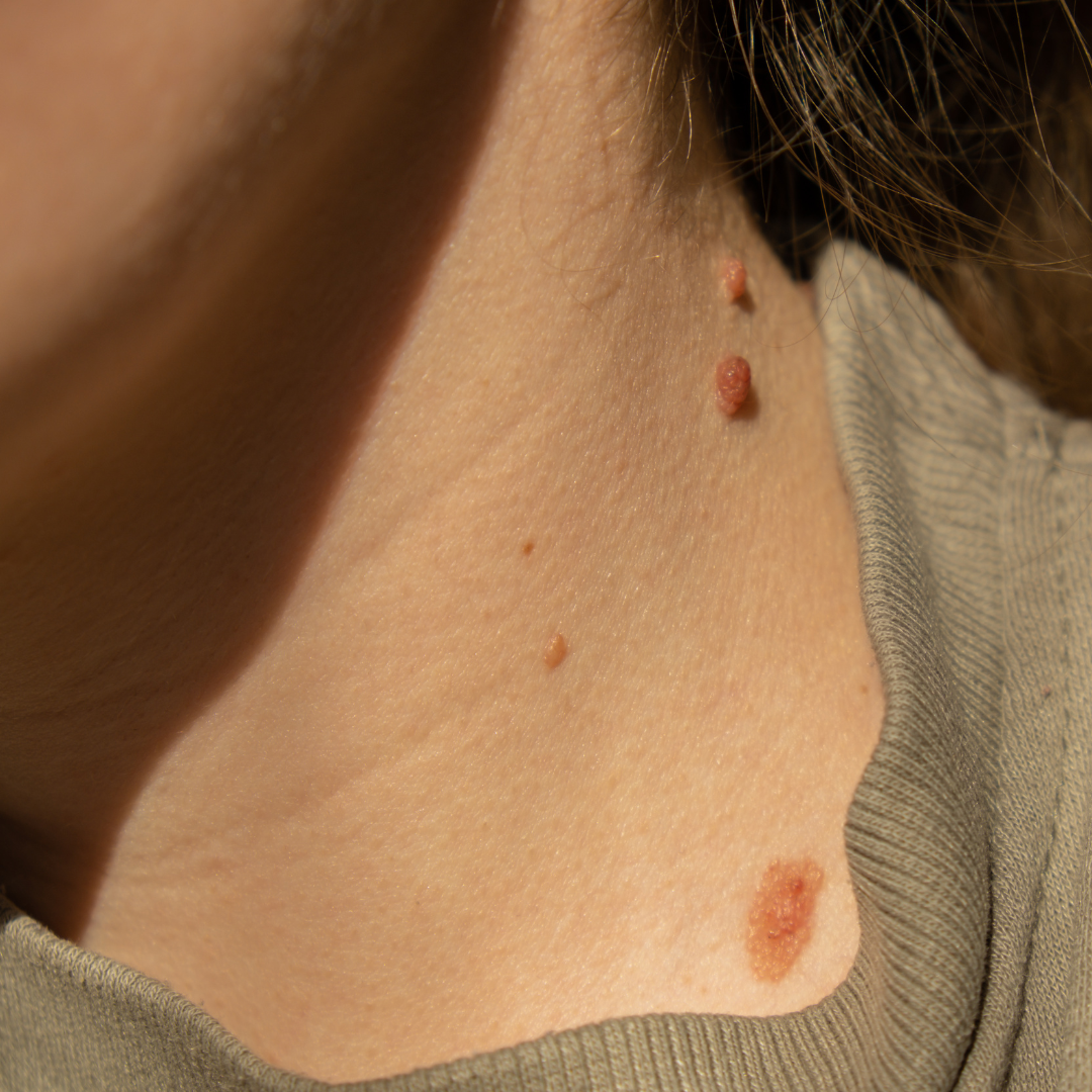 seborrheic keratosis sacramento