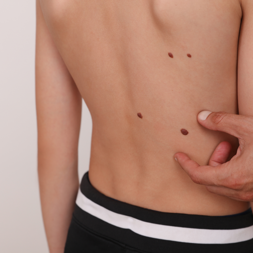 risks of DIY mole removal
