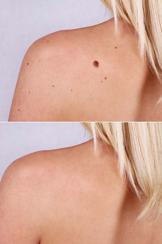 What to Expect During Mole Removal in Sacramento
