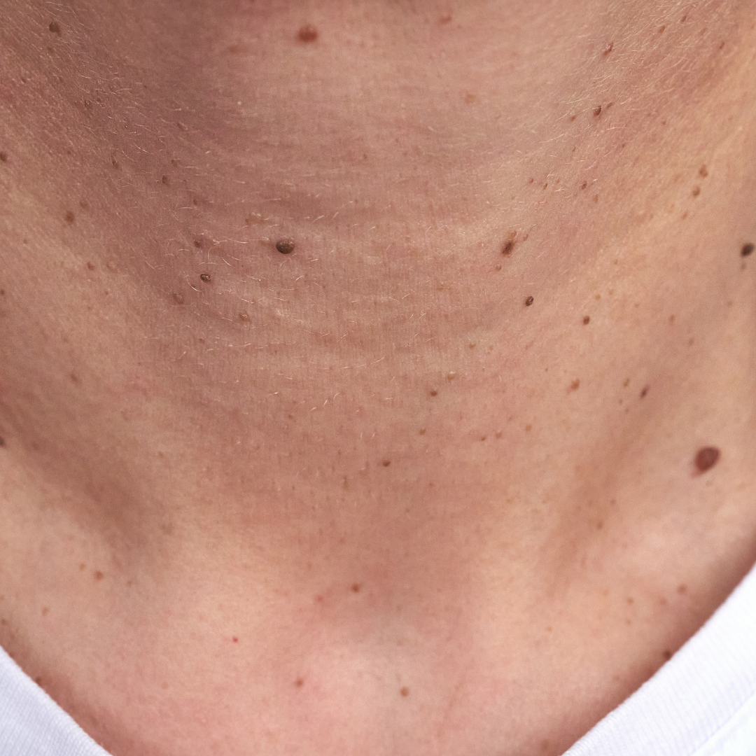 Your Guide to Mole Removal on the Neck