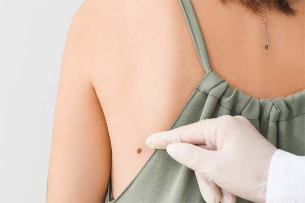 affordable mole removal elk grove california