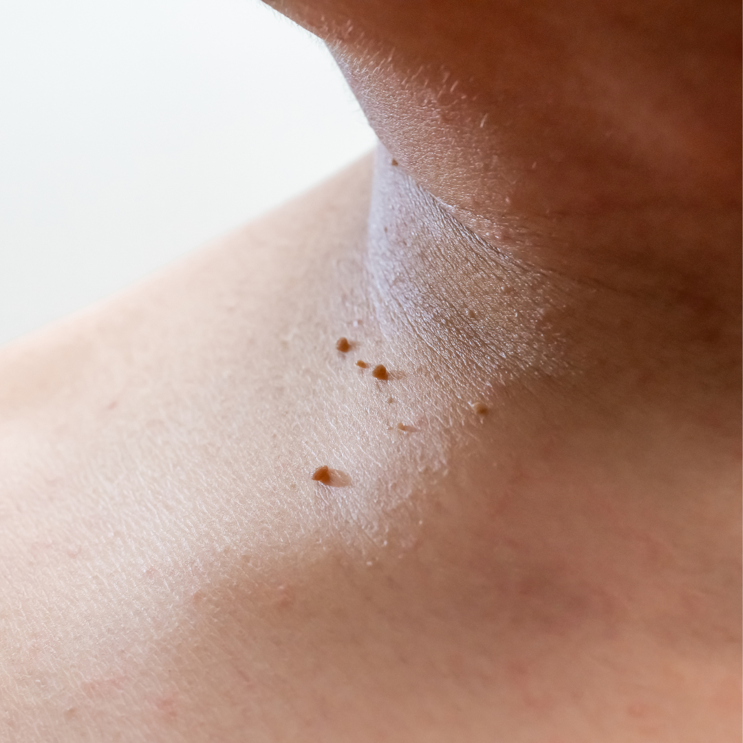 expert mole removal Rancho Murieta california